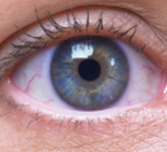 טיפות סטרואידים לעיניים - תמונת אווירה